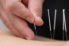 Acupuncture pic